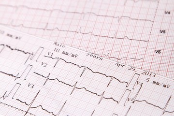 Electrocardiogram to monitor heart
