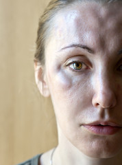 Cosmetology.Beauty pricks.Hypostasis in places of introduction  