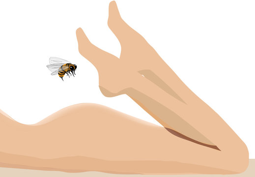 puntura d' insetto