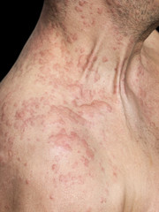 Man's shoulder covered with skin Allergy