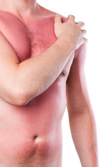 Man with a sunburn