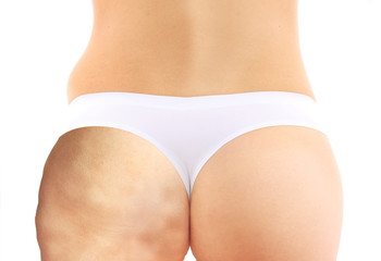 Woman body, half with cellulite.