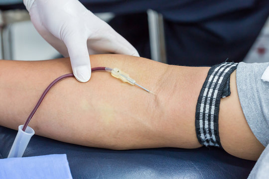 A large bore needle is inserted for blood donation