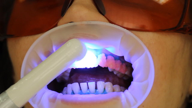 Teeth Whitening. Activation of the gel polymerization light. 
