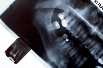 X-ray scan of humans teeth