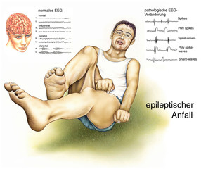 Epilepsie.EEG.Krampf-Anfall