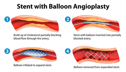 Stent angioplasty procedure