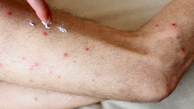 allergy on legs