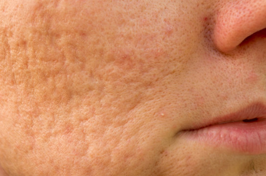 problematic skin with acne scars