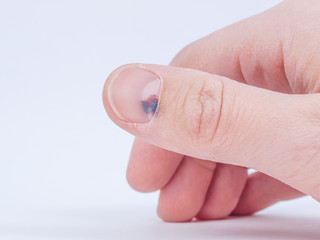 Subungual hematoma under nail