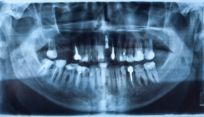 dental X-Ray