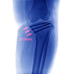 x ray of fractures bone