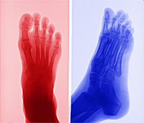 X-ray picture of foot