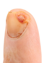 Fototapeta premium Finger cut with knife, not imitated, ten days after unjury
