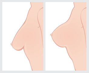 Breast Uplift before and after surgery
