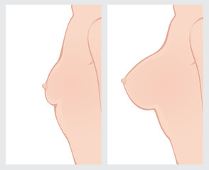 Breast enlargement before and after surgery