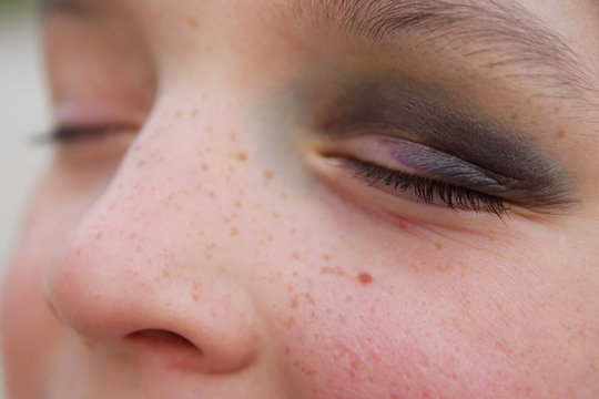 contusion