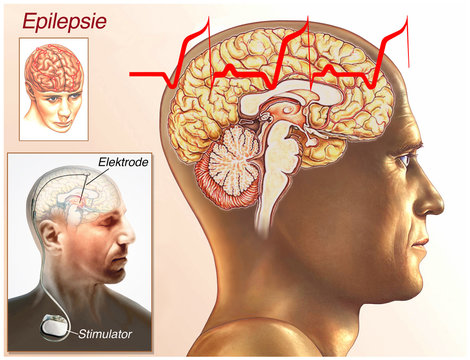 Epilepsie.EEG.Hirnschrittmacher