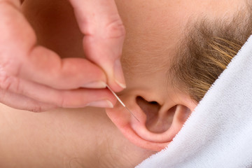 Close-up of an acupuncture needle on an ear. - obrazy, fototapety, plakaty