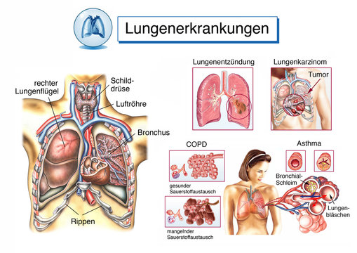 Lungenerkrankungen