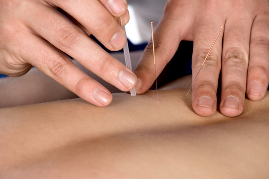 Physiotherapist doing accupuncture
