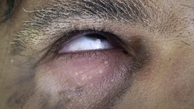 Old man eye fainted or dead