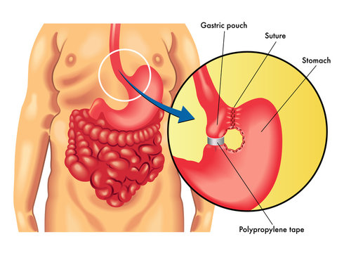 gastroplastica verticale
