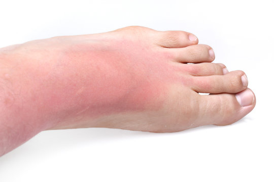 Sunburn
