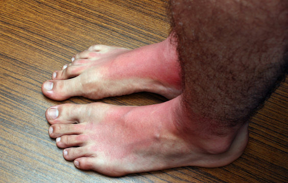 Sunburn feets