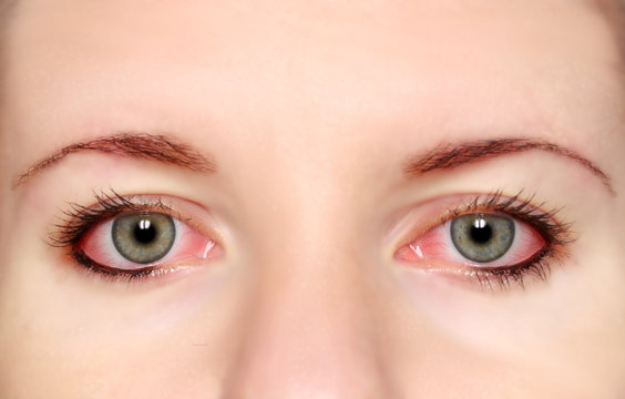 Closeup of irritated red bloodshot eye