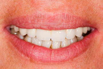 Obraz premium Porcelain teeth in human mouth