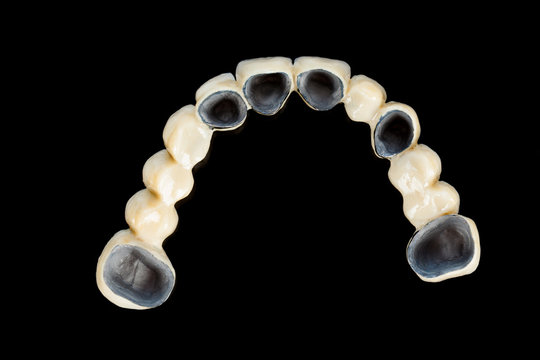 Porcelain teeth - dental bridge