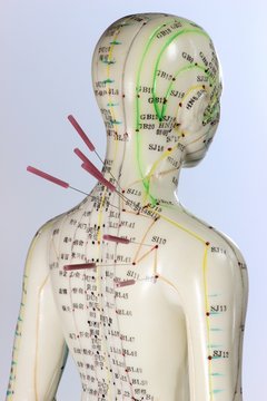 weibliches Akupunkturmodell mit Nadeln im Schulterbereich