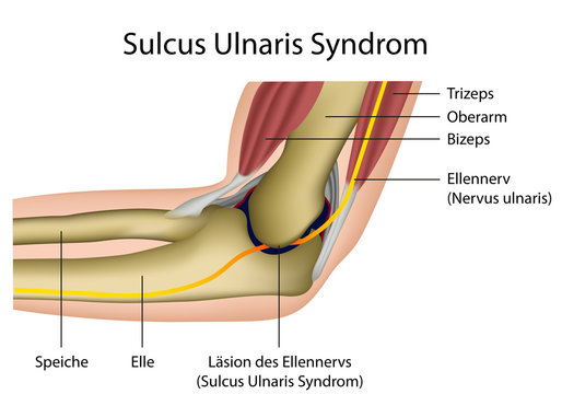 Sulcus Ulnaris Syndrom