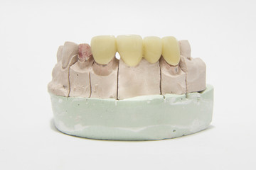 All ceramic highly aesthetic dental bridge and crown on gypsum m