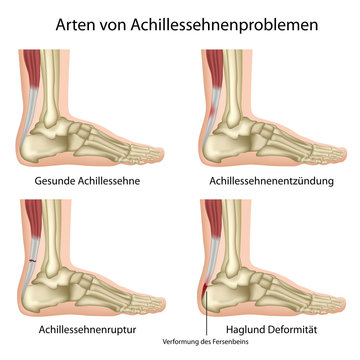 Probleme der Achillessehne