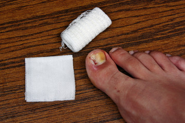 Treatment after the removal of ingrown toenail