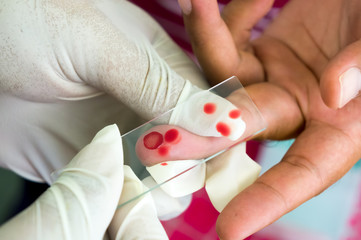 Taken Blood film for Malaria - obrazy, fototapety, plakaty