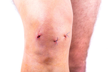 Naklejka premium Man knee after arthroscopic surgery with stitches
