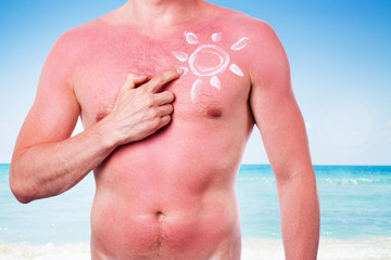 Man with a sunburn