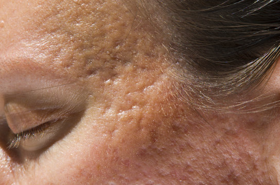 acne scars on temples