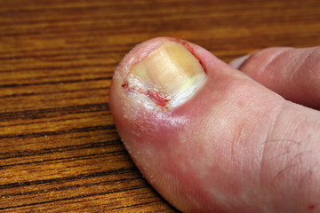 Infection in the nail toe