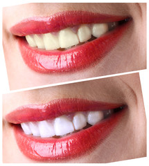 Women smile with teeth: whitening - bleaching treatment ,