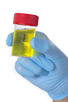 &Eacute;chantillon urinaire - analyse m&eacute;dicale