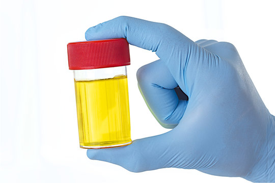 &Eacute;chantilon d'urine - Analyse m&eacute;dicale