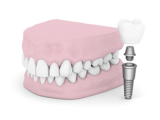 Dental implants