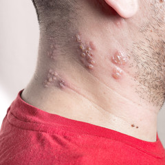 shingles virus