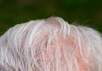 Hair thinning on senior man scalp