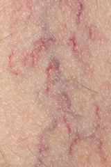 Fototapeta premium varicose veins on the skin. Macro