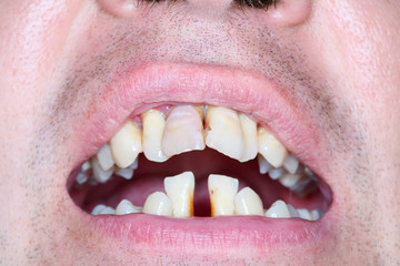 Rotten and crooked teeth of men.